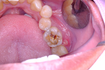 What Is a Tooth Filling? Understanding the Process