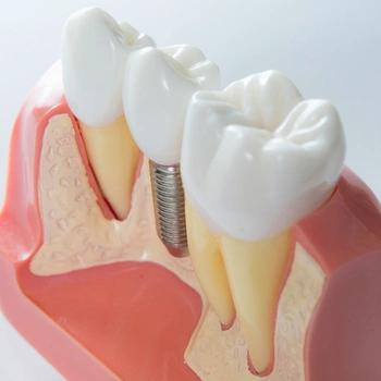 Dental Implant Fell Out appearance