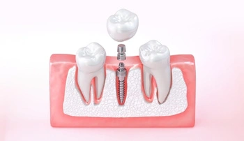 Dental Implant Fell Out parts