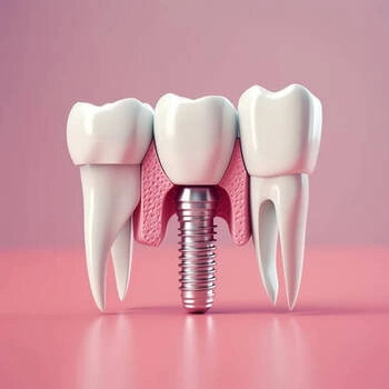 dental implant image showing parts
