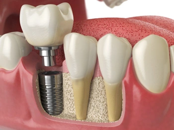 Before and after photo of a patient's smile, showing the replacement of a missing front tooth with a natural-looking implant crown