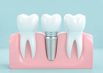 Dental Implant single