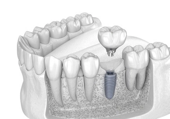 Illustration of the stages of osseointegration, with the titanium screw fusing with the jawbone.
